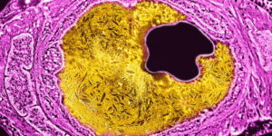 editarea-genelor-crispr-s-a-dovedit-a-reduce-permanent-colesterolul-ridicat