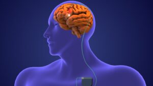 stimularea-electrica-ar-putea-trata-leziunile-traumatice-ale-creierului