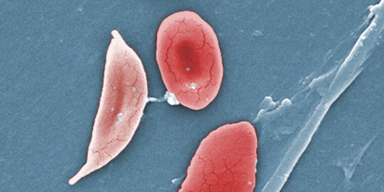 fda-aproba-prima-terapie-crispr-–-iata-cum-functioneaza-impotriva-celulelor-falciforme
