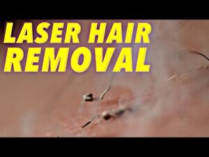 Știința îndepărtării părului cu laser în mișcare lentă
