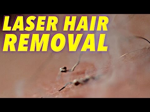 Știința îndepărtării părului cu laser în mișcare lentă