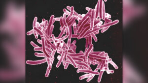 al-doilea-focar-de-tuberculoza-legat-de-grefele-osoase-in-sua