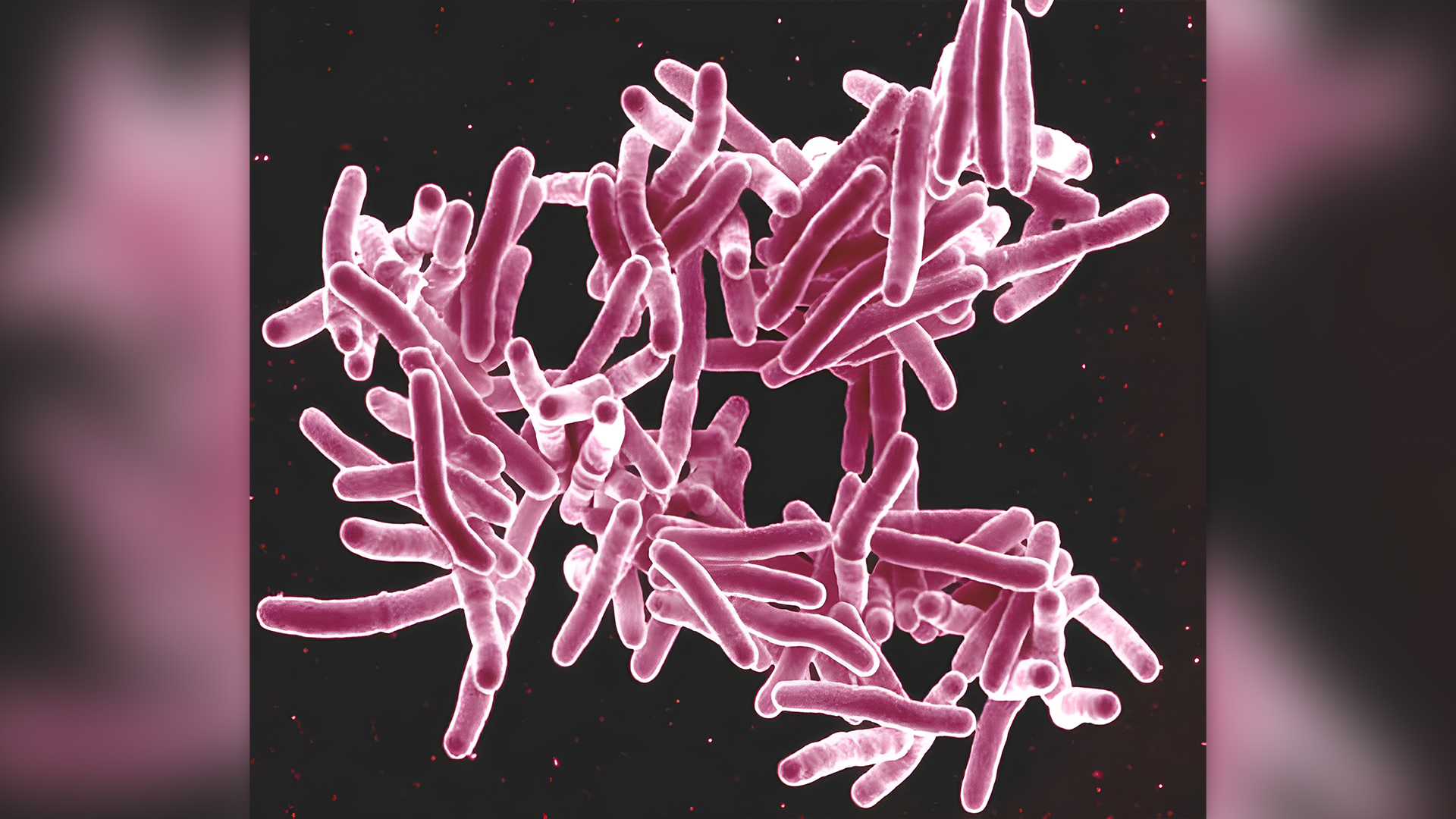 al-doilea-focar-de-tuberculoza-legat-de-grefele-osoase-in-sua