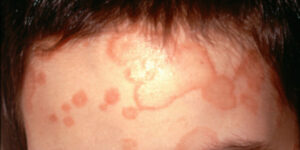antifungicele-merg-pe-calea-antibioticelor-–-suprautilizate,-lovind-rezistenta