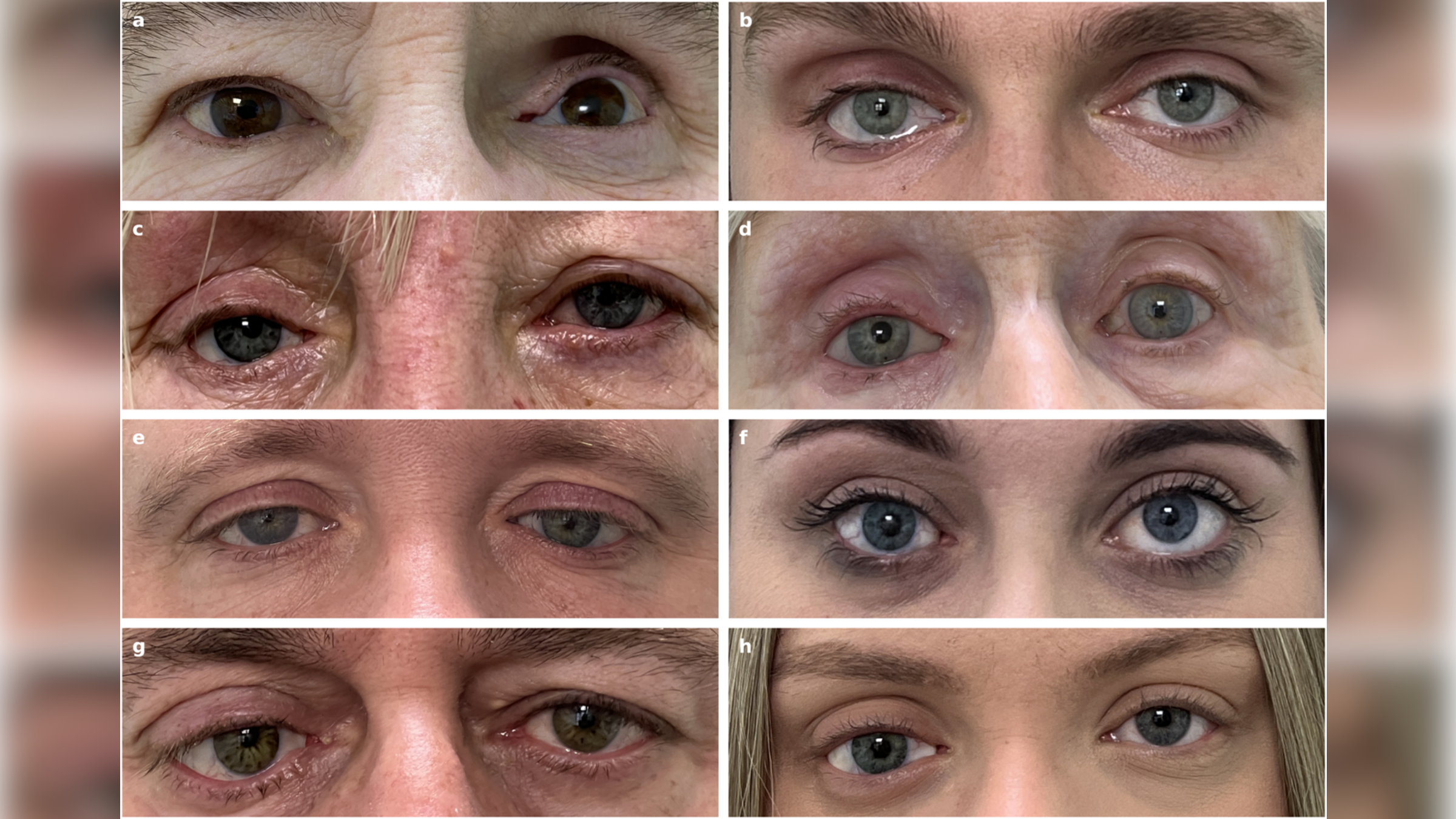ochi-protetici-super-realisti-realizati-in-timp-record-cu-imprimare-3d
