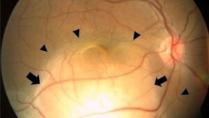 orbirea-brusca-a-femeii-intr-un-ochi-a-dezvaluit-cancer-pulmonar-ascuns