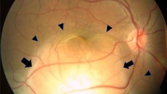 orbirea-brusca-a-femeii-intr-un-ochi-a-dezvaluit-cancer-pulmonar-ascuns