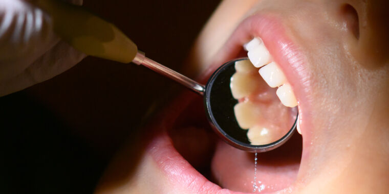 ai-nevoie-de-o-vizita-la-dentist-la-fiecare-6-luni?-acea-umplutura?-datele-sunt-slabe