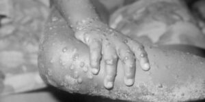 un-nou-focar-de-mpox-trage-alarma;-oms-ia-in-considerare-declararea-de-urgenta-internationala