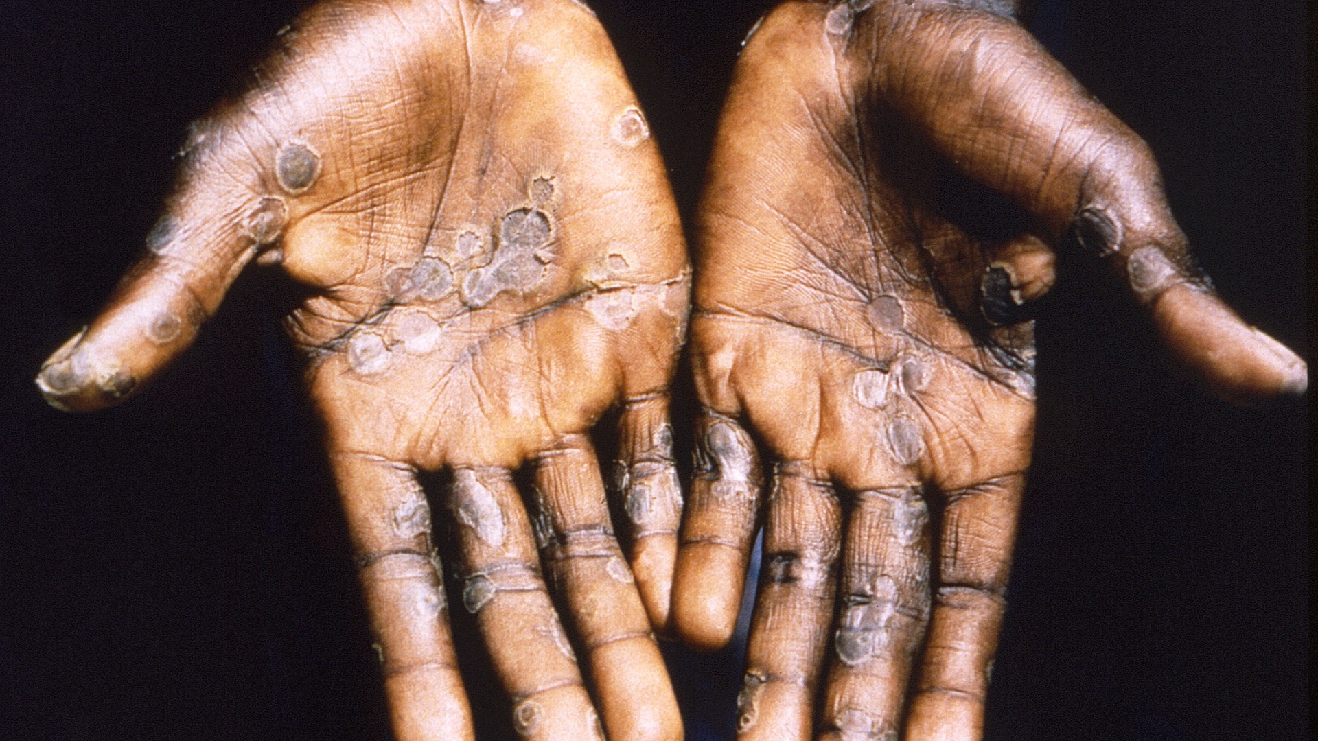 focarul-de-mpox-din-africa-s-ar-putea-transforma-intr-o-pandemie-–-iata-cum-o-oprim