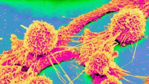 riscul-de-cancer-de-colon-la-tineri-este-legat-de-un-aminoacid,-arata-un-studiu-mic