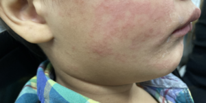 focar-record-de-rujeola-din-oregon-este-pus-pe-seama-scutirilor-de-vaccinuri