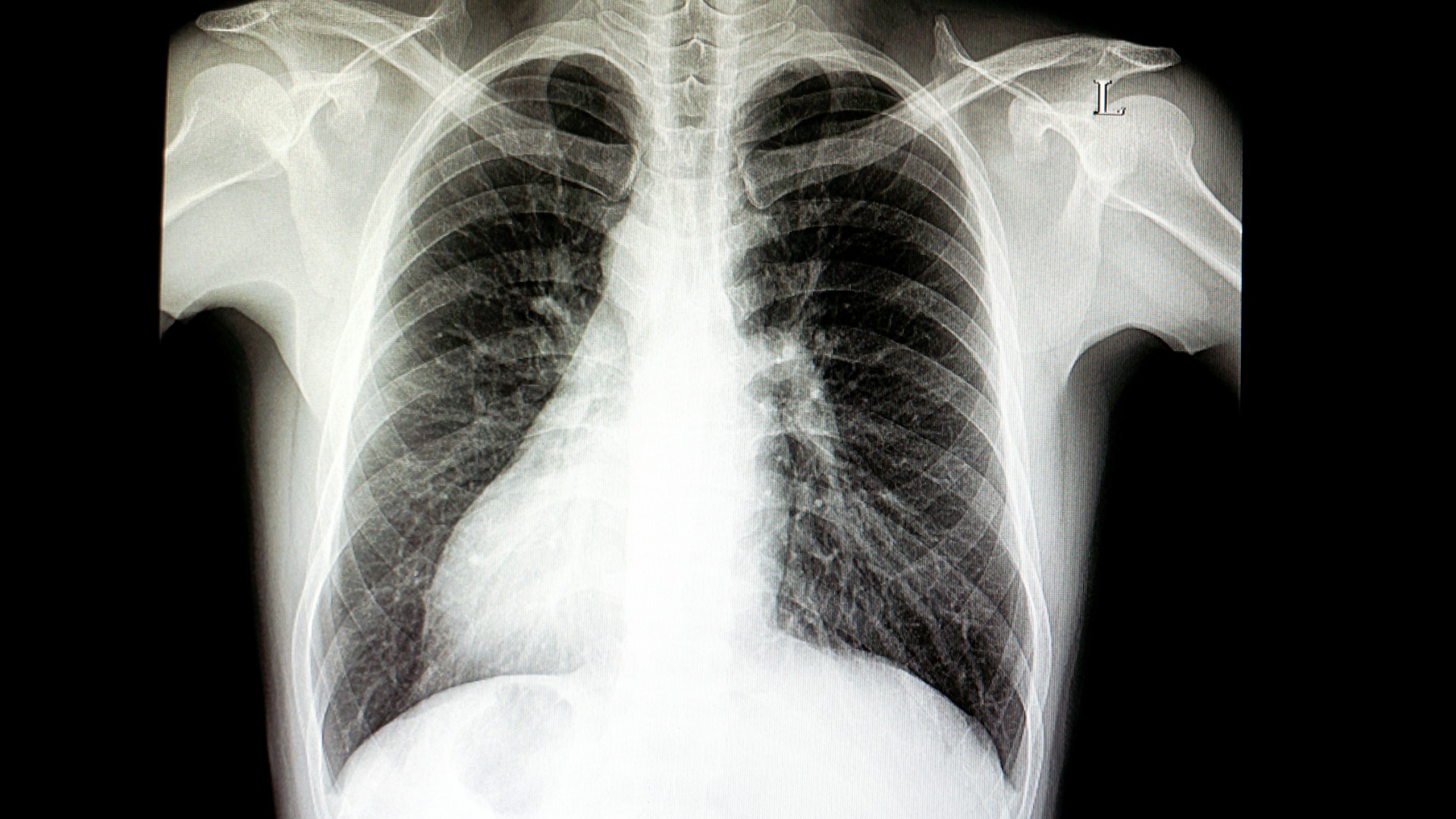 situs-inversus:-afectiunea-in-care-organele-tale-sunt-pe-partea-„gresita”.