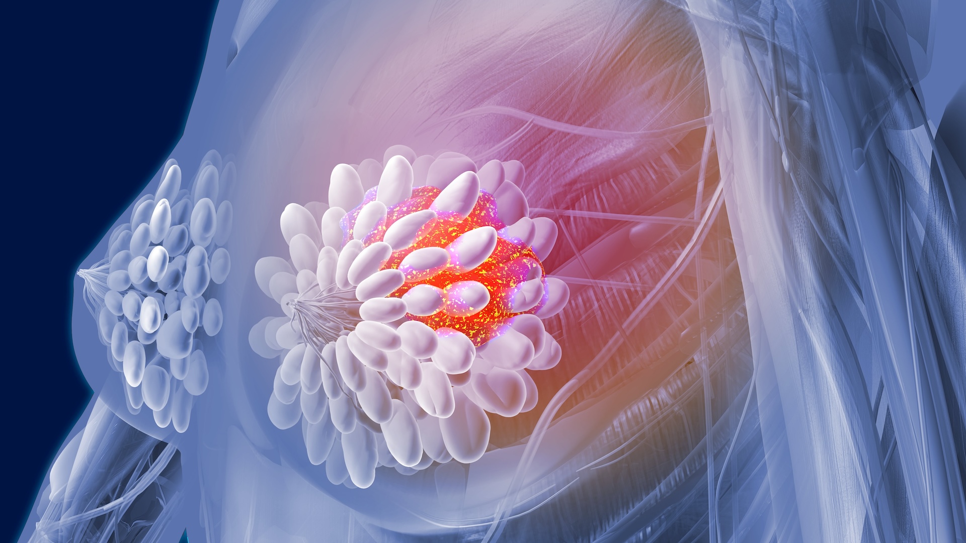 celulele-mamare-sanatoase-pot-arata-ca-un-cancer-invaziv,-complicand-diagnosticul-precoce