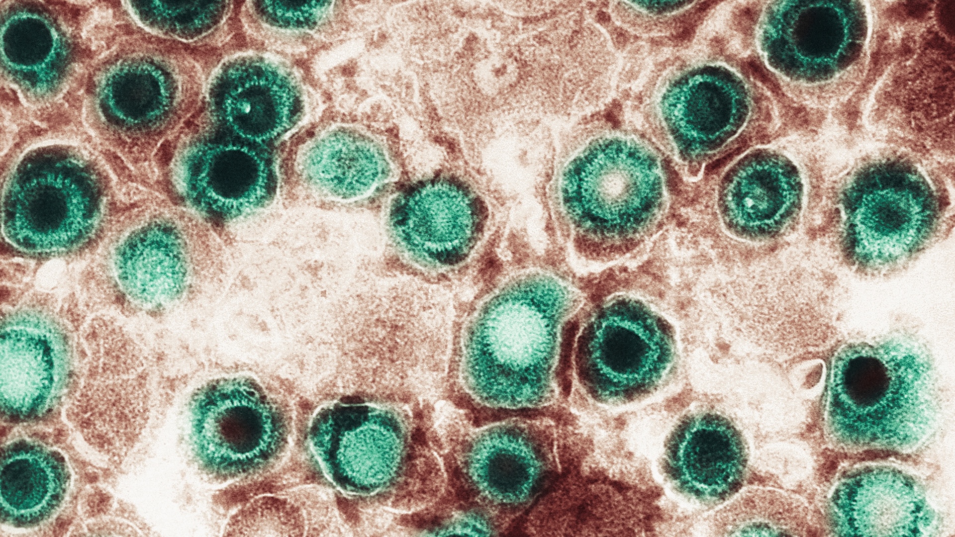 virusii-herpes-„reanimati”-care-pandesc-in-creier-pot-lega-comotiile-si-dementa