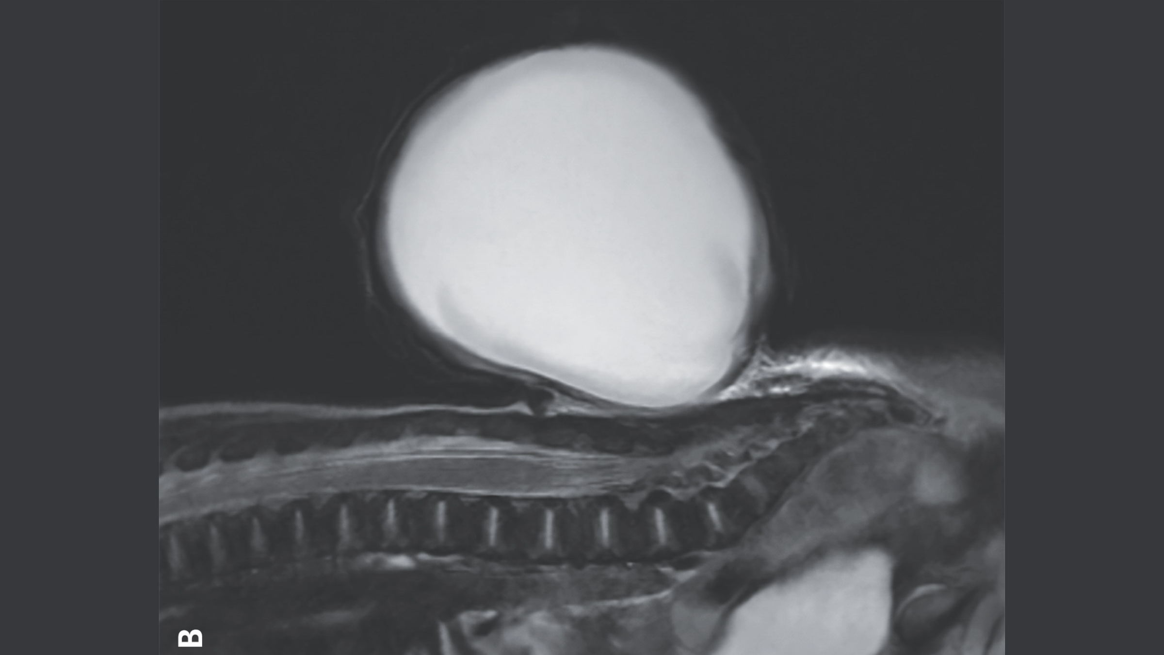 „baloanele-rosii”-inmuguresc-din-spatele-bebelusului-din-cauza-unui-defect-congenital