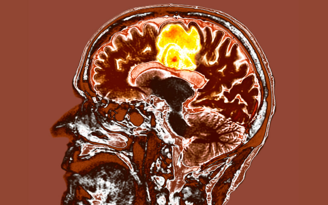 Noul tratament pentru cancerul cerebral cel mai agresiv poate ajuta pacienții să trăiască mai mult