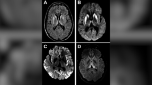 boala-exceptional-de-rara-care-determina-formarea-gaurilor-in-creierul-tau
