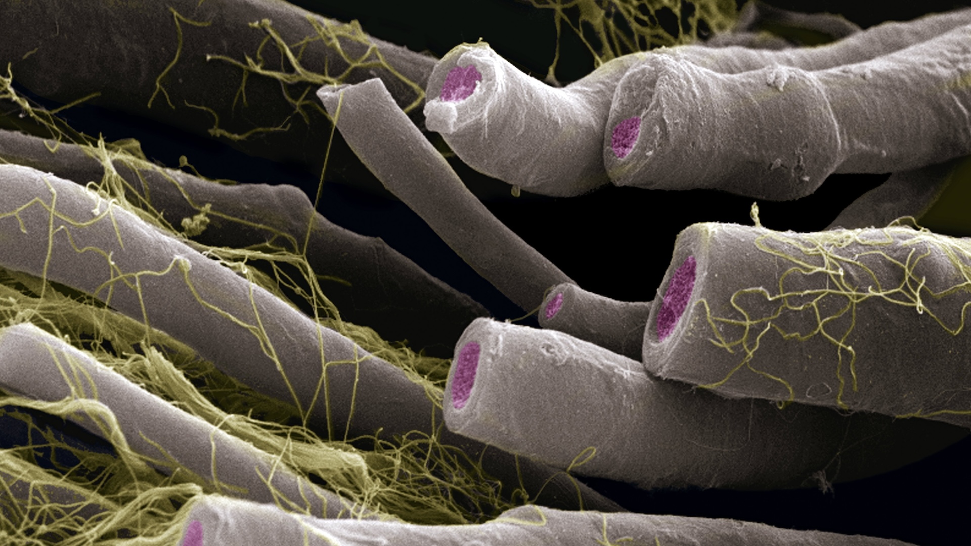 dezechilibrul-bacteriilor-intestinale-legat-de-scleroza-multipla