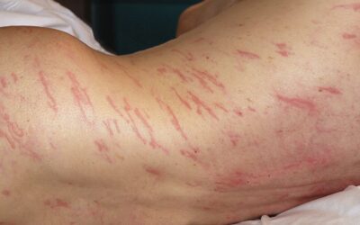 Dilemă de diagnostic: o erupție „a migrat” pe corpul unui bărbat din anusul său
