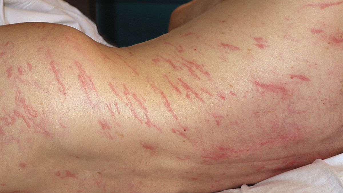 dilema-de-diagnostic:-o-eruptie-„a-migrat”-pe-corpul-unui-barbat-din-anusul-sau