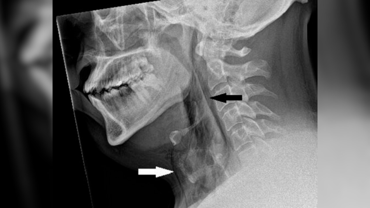 dilema-de-diagnostic:-un-barbat-tinut-intr-o-stranut-–-si-i-a-perforat-papara-de-vant