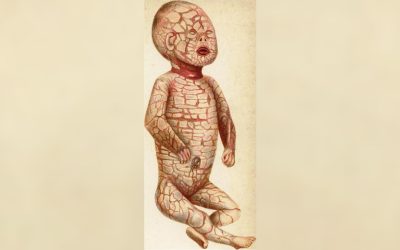 Harlequin Ichthioză: boala genetică rară care le oferă bebelușilor „cântare” grele