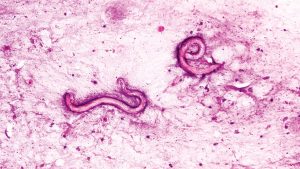 corpul-barbatului-care-se-taraie-cu-viermi-paraziti-dupa-transplantul-de-rinichi-infectat-la-spitalul-american