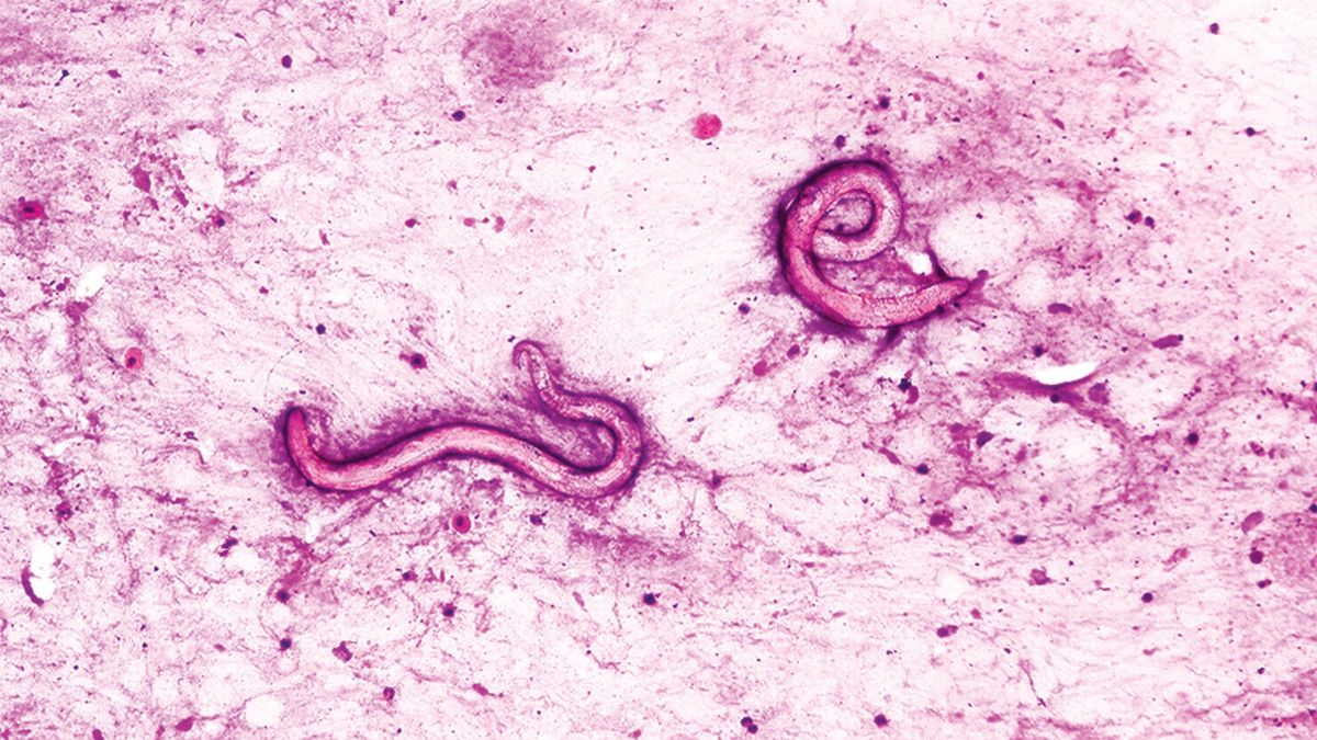 corpul-barbatului-care-se-taraie-cu-viermi-paraziti-dupa-transplantul-de-rinichi-infectat-la-spitalul-american
