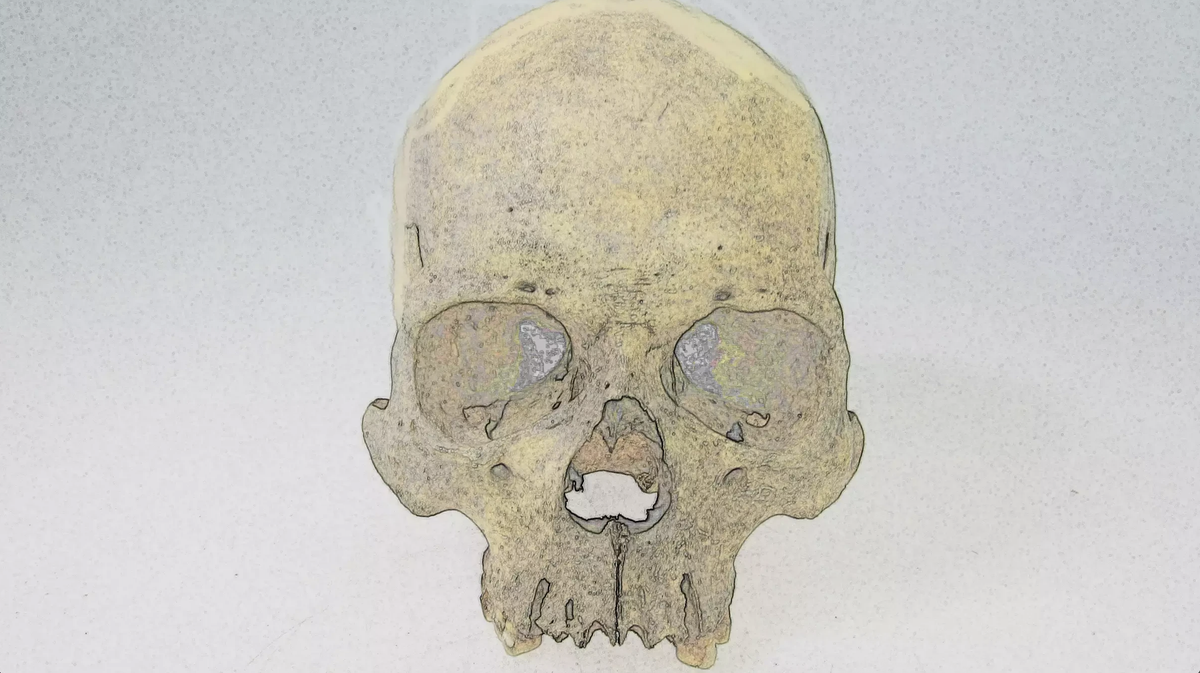 forma-rara-de-lepra-infectate-in-america-inainte-de-sosirea-europeana,-oasele-vechi-de-4.000-de-ani-sugereaza