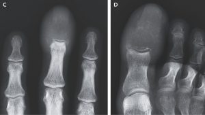 umflarea-ciudata-a-degetelor-si-degetelor-de-la-picioare-a-dezvaluit-ca-cancerul-a-„inlocuit-complet”-oasele-cu-leziuni