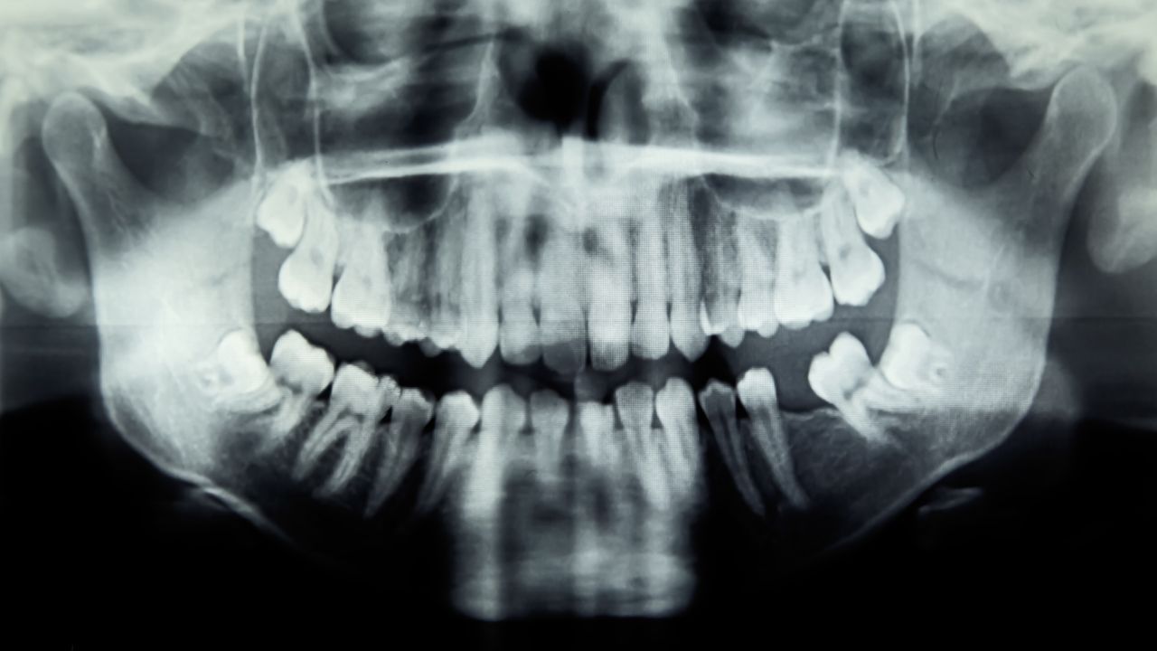 dilema-de-diagnostic:-problema-dentara-a-fetei-au-provocat-o-infectie-a-ochilor-care-poate-pune-viata-in-pericol