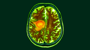 schimbarea-dietei-ar-putea-face-cancerul-cerebral-mai-usor-de-tratat,-indicii-de-studiu-timpuriu